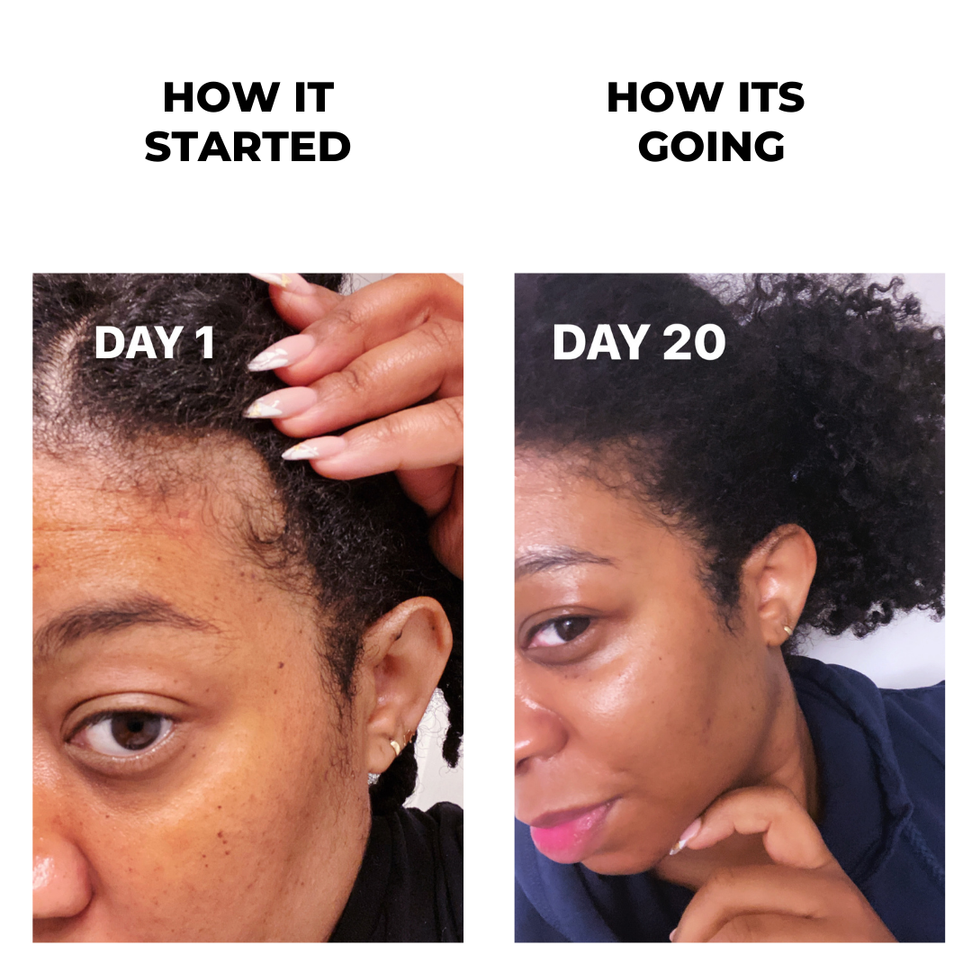 Hair Growth Results From Bald Spot to Full Edges